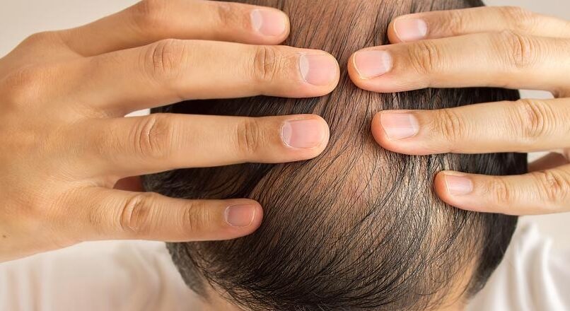 Boom dei Trapianti di Capelli: grande successo della Turchia come destinazione