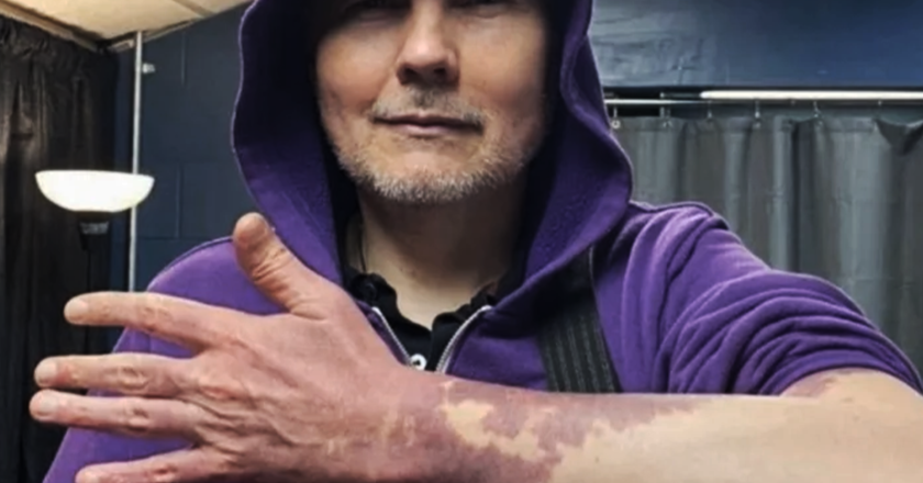 Billy Corgan Celebra la Sua Unicità Mostrando il Nevo Vinoso